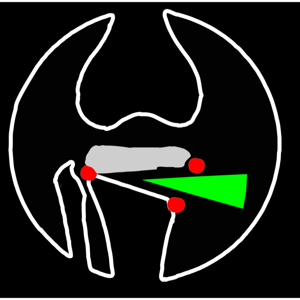 OsteotomyApp